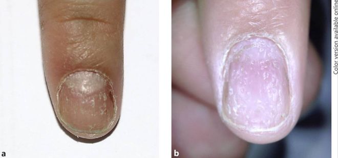 孩子指甲軟薄易斷、月牙少、長(zhǎng)白點(diǎn)、豎紋是顯示身體有健康風(fēng)險(xiǎn)嗎？(圖7)