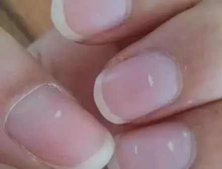 孩子指甲軟薄易斷、月牙少、長(zhǎng)白點(diǎn)、豎紋是顯示身體有健康風(fēng)險(xiǎn)嗎？(圖6)