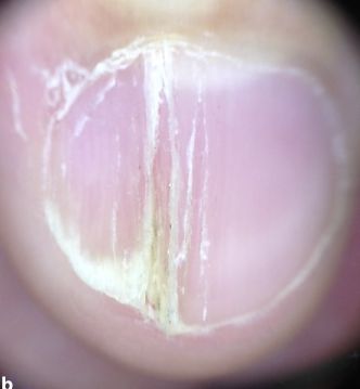 孩子指甲軟薄易斷、月牙少、長(zhǎng)白點(diǎn)、豎紋是顯示身體有健康風(fēng)險(xiǎn)嗎？(圖11)