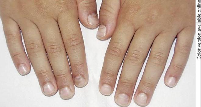 孩子指甲軟薄易斷、月牙少、長(zhǎng)白點(diǎn)、豎紋是顯示身體有健康風(fēng)險(xiǎn)嗎？(圖10)
